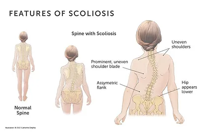 Baltimore-Physical-Therapist-scoliosis.jpg